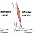 Atrofija mišića noge ili ruke – uzrok, simptomi i tretman